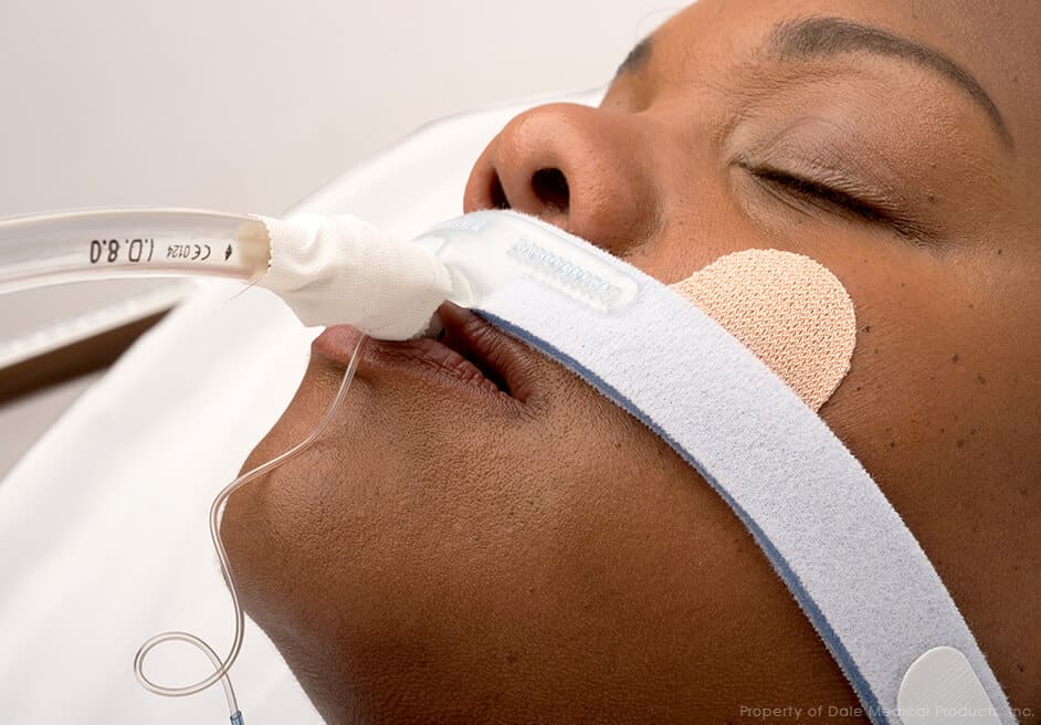 Dale Stabilock Endotracheal Neck Band Adults (270)